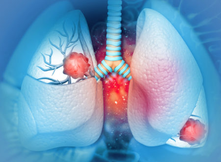 Verdubbelde ziektevrije overleving met osimertinib bij niet-kleincellig longcarcinoom